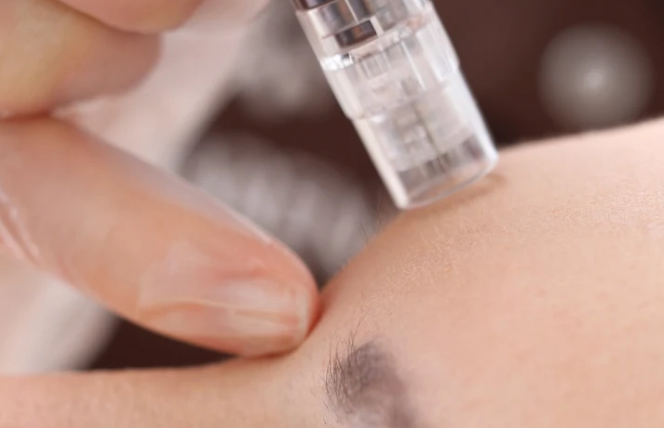 Microneedling Treatment Result 1