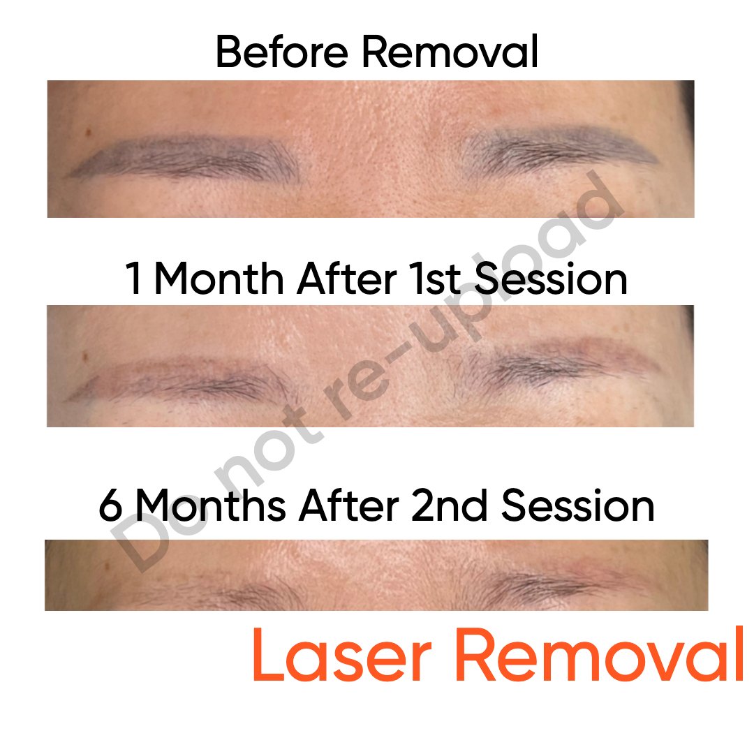 Tattoo Removal Result 1